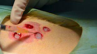 Una nueva terapia regenerativa reduce el tiempo de cicatrización en heridas agudas