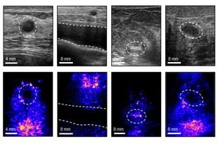 Desarrollan un sistema de ultrasonido portátil para mejorar la detección de cáncer de mama