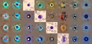 Nueva herramienta de IA mejora diagnóstico de anomalías en células sanguíneas