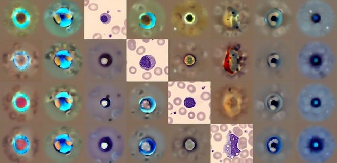 Nueva herramienta de IA mejora diagnóstico de anomalías en células sanguíneas