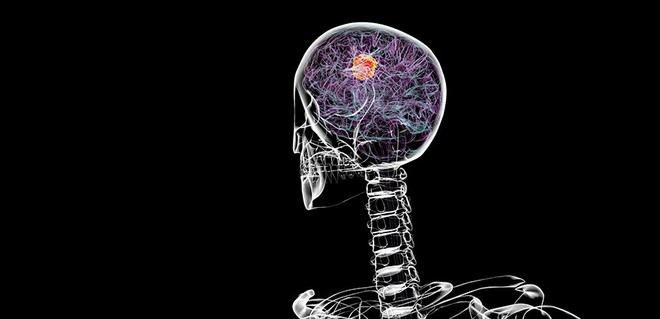 Investigadores logran frenar la propagación de células cancerosas en el cerebro