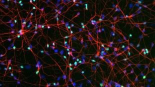 Un nuevo hallazgo revela cómo un enzima defectuoso provoca la muerte de células nerviosas en la demencia