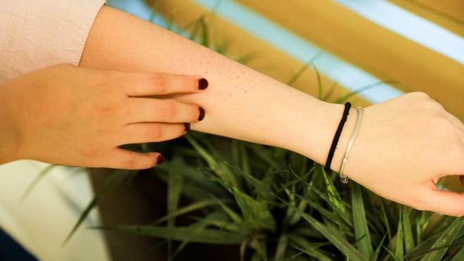 Aumento del 20% en consultas por alergias respiratorias en Nuevo León