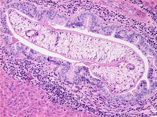 Nuevos biomarcadores mejoran diagnóstico de infecciones hepáticas y cáncer biliar