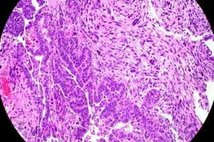 Nuevo enfoque terapéutico para el cáncer de endometrio identificado en investigación catalana