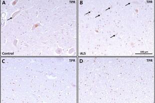 Investigación sobre poros nucleares revela su importancia en la esclerosis lateral amiotrófica