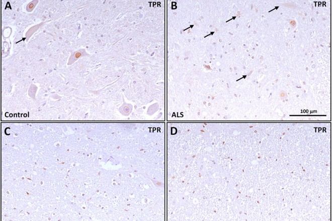 Investigación sobre poros nucleares revela su importancia en la esclerosis lateral amiotrófica
