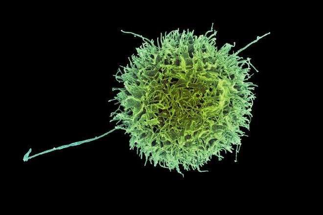 Células inmunitarias modificadas podrían ser clave en la lucha contra el cáncer