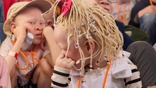 Estudiantes de la USC desarrollan un proyecto para prevenir el cáncer en personas con albinismo en África