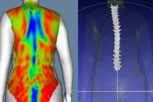 IBV desarrolla metodologías innovadoras para el estudio de deformidades de la columna vertebral mediante escaneo corporal dinámico