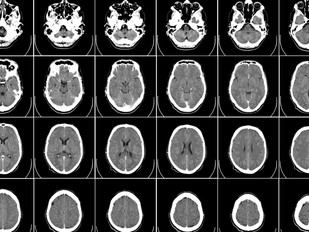 Nuevos hallazgos del Hospital Universitari Institut Pere Mata mejoran la predicción del trastorno bipolar
