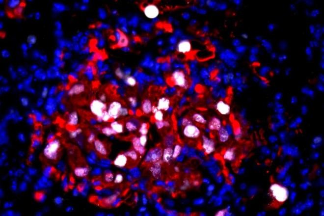 Inflamación despierta células cancerosas inactivas, permitiendo su multiplicación