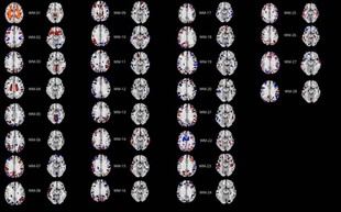 Estudio revela nuevos hallazgos sobre el Trastorno de la Personalidad Obsesivo-Compulsiva en la ULL