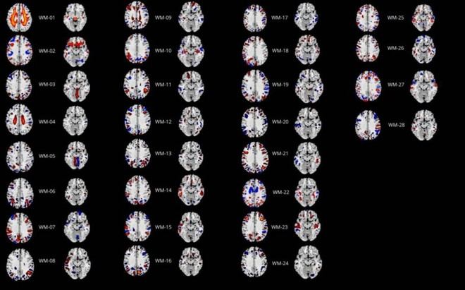 Estudio revela nuevos hallazgos sobre el Trastorno de la Personalidad Obsesivo-Compulsiva en la ULL