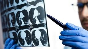La inteligencia artificial facilita la comprensión de informes de CT para pacientes con cáncer