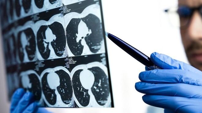 La inteligencia artificial facilita la comprensión de informes de CT para pacientes con cáncer