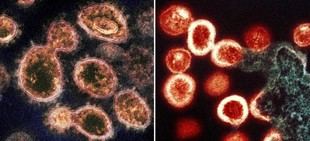 Persistencia del SARS-CoV-2 en personas con VIH: un nuevo perfil de microARN descubierto tras la COVID-19