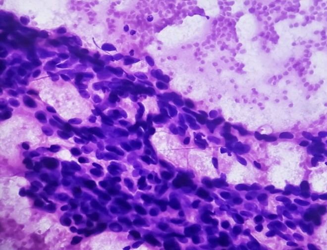 Inicia el primer proyecto de la plataforma RST Biomed del CSIC contra la metástasis
