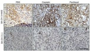 Nuevas esperanzas en el tratamiento del cáncer de ovario con radioyodo