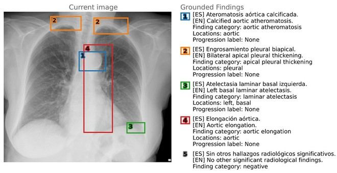 La Universidad de Alicante lanza un innovador conjunto de datos para radiología en IA médica