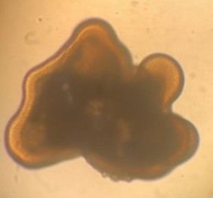 Retina cultivada en laboratorio revela pistas sobre una rara condición ocular infantil