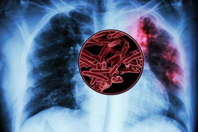Investigadores del MIT identifican antígenos para una nueva vacuna contra la tuberculosis