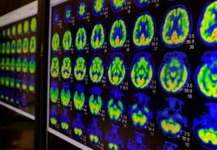 Estudio de escaneo cerebral podría revolucionar el tratamiento de la psicosis
