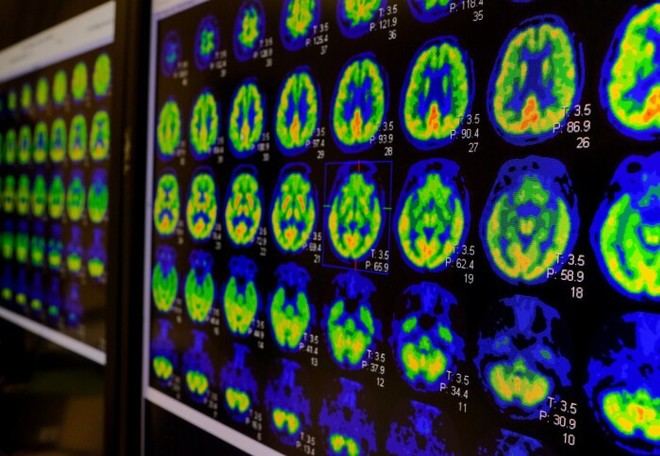 Estudio de escaneo cerebral podría revolucionar el tratamiento de la psicosis