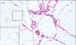 Nuevos tratamientos prometen combatir la fibrosis en personas con obesidad