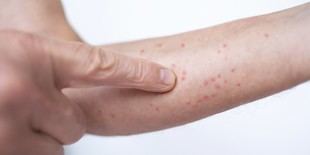 España pierde el estatus de país libre de sarampión según la OMS