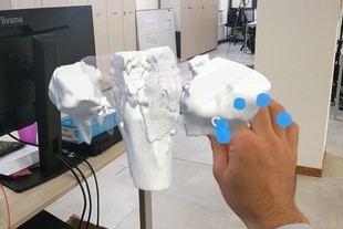 Avances en realidad aumentada mejoran la cirugía de fracturas complejas