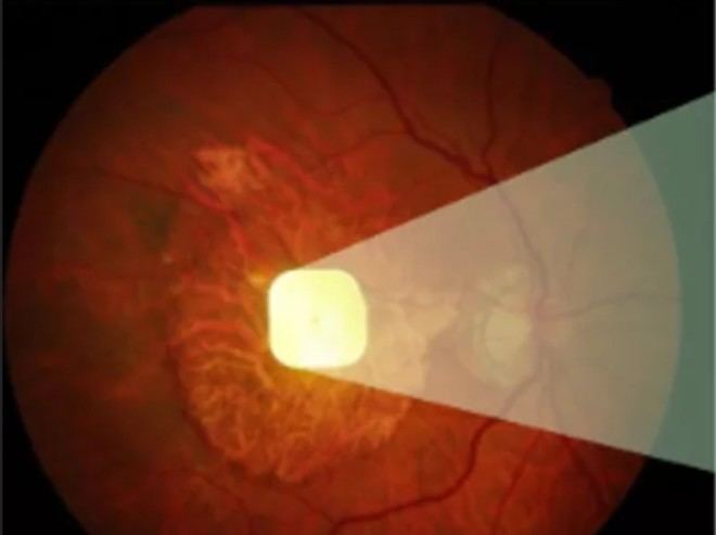 Innovador implante ocular mejora la visión en pacientes con DMLA atrofica