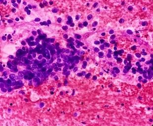 Investigación explica la agresividad del cáncer epitelial en diferentes tejidos