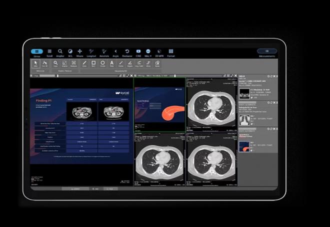 Sycai Medical desarrolla un sistema innovador para detectar cáncer de páncreas gracias al apoyo del CDTI y fondos europeos