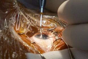 El Dr. Óscar Asís se somete a una cirugía ocular en vivo con lente de IA en FacoElche