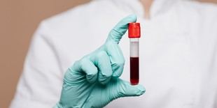 UIC Barcelona avanza en el diagnóstico temprano de la hemocromatosis