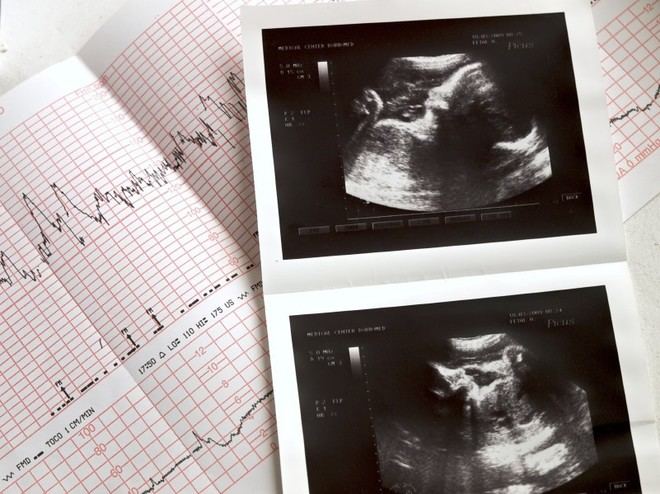 Las mujeres embarazadas vacunadas contra COVID-19 presentan síntomas más leves y menos complicaciones