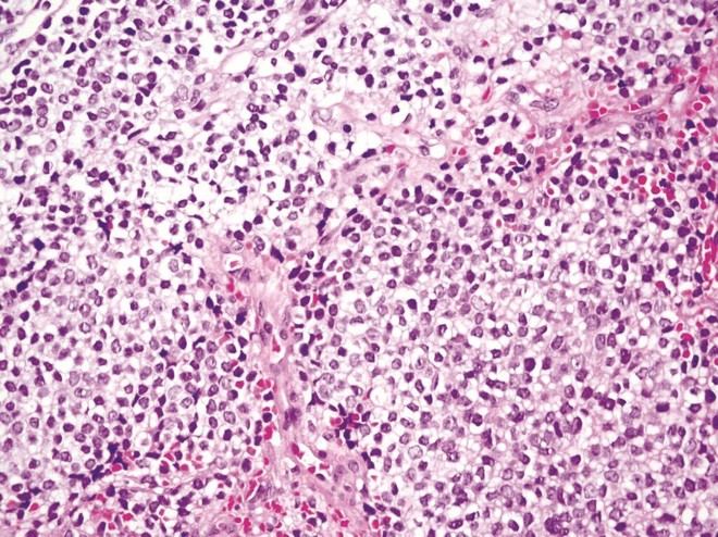 Nuevo hallazgo sobre la sensibilidad del sarcoma de Ewing a la quimioterapia