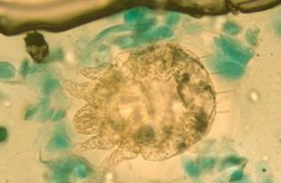 Aumentan significativamente los casos de sarna en España, según un estudio del ISCIII