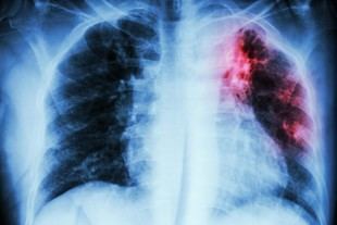 Nuevo método identifica variantes genéticas de la bacteria de la tuberculosis