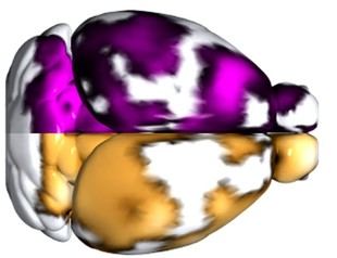 Nueva técnica de imagen identifica microtrombos en pacientes con Alzheimer