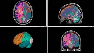 Desarrollan un atlas cerebral de alta resolución para mejorar diagnósticos neurológicos